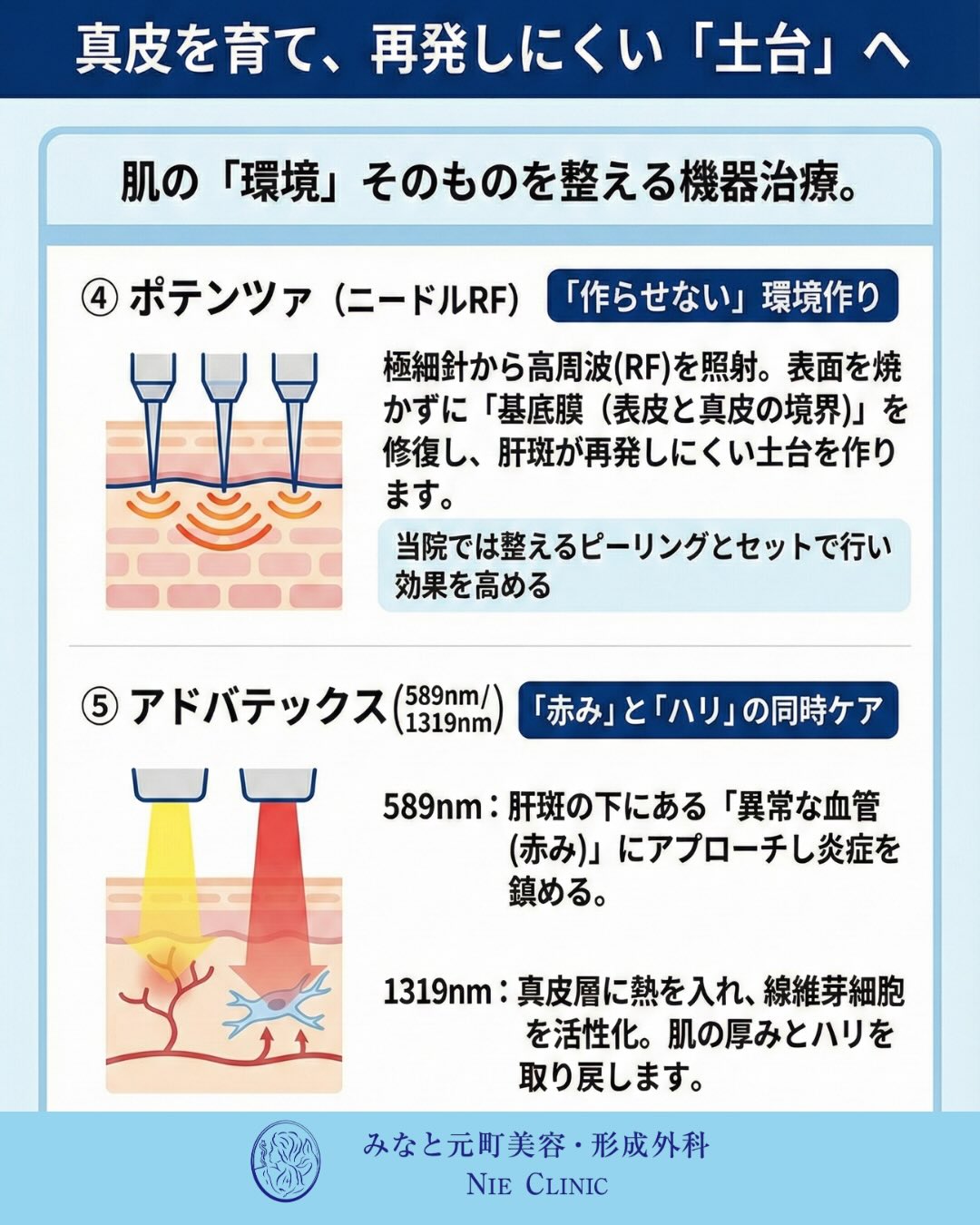 肝斑治療でポテンツァとADVATxの役割を分ける図解